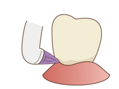 歯の間の汚れ除去