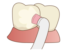 フッ素塗布